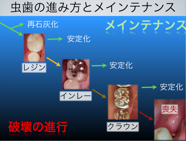 むし歯の進み方